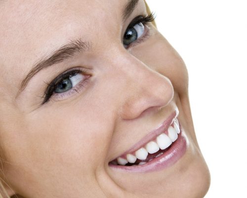Clarity braces